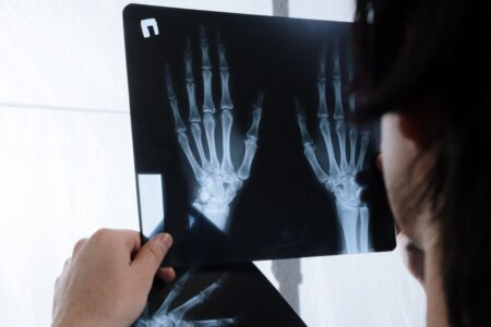 Access and Affordability of Biologics in Rheumatoid Arthritis Treatment